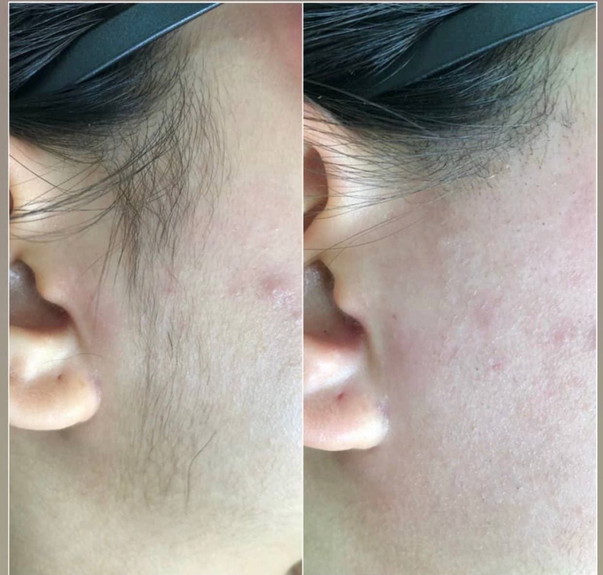 Лазерна епіляція image 4