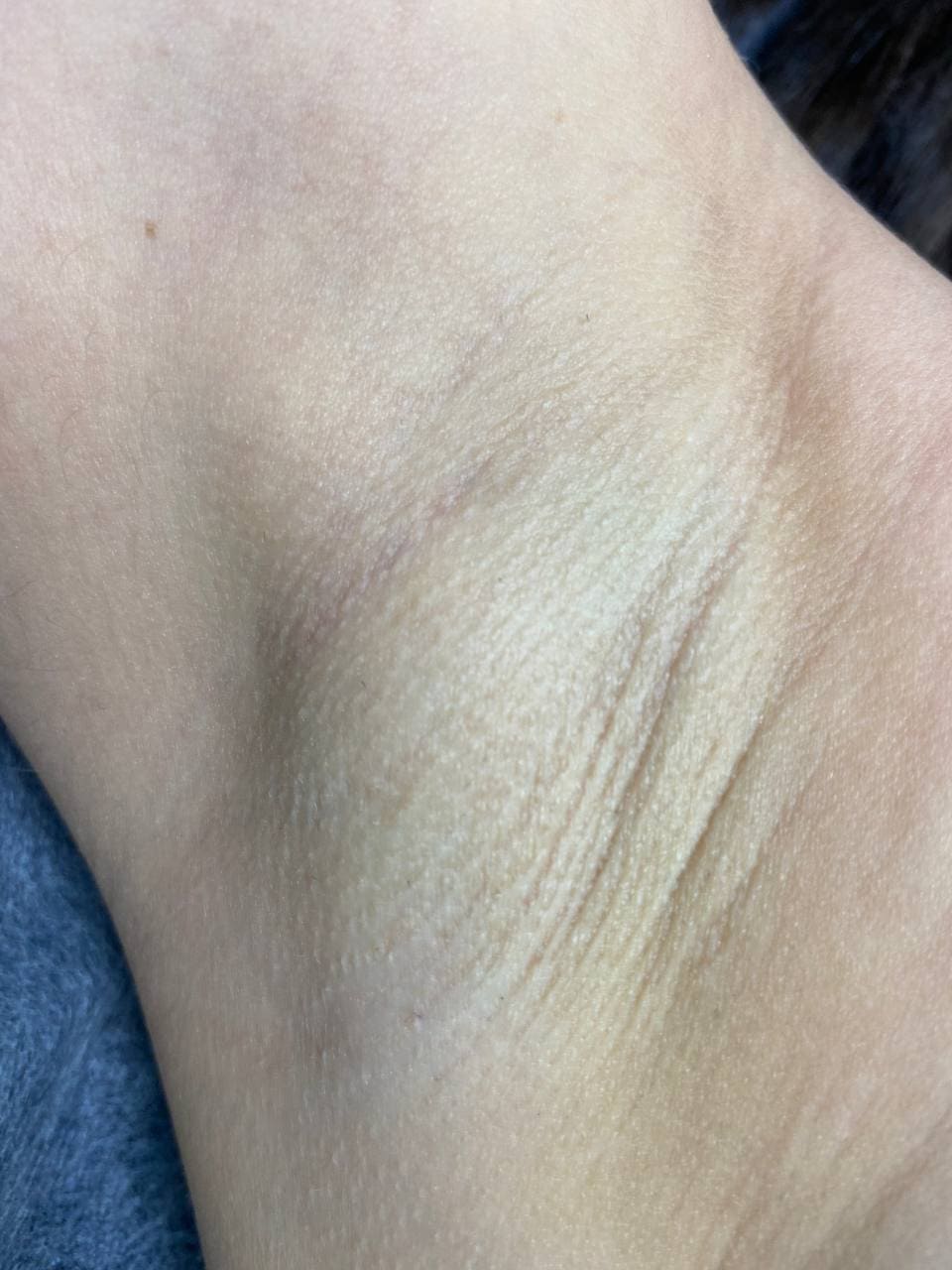 Лазерна епіляція image 5